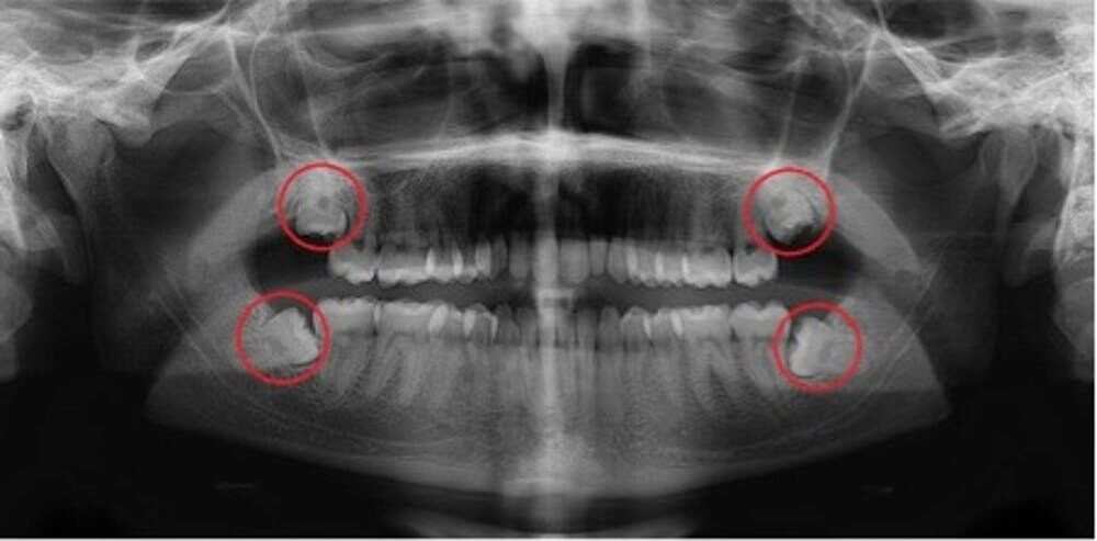 Extraction of Wisdom Teeth - Dr. Shmuel Katz